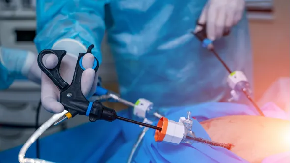 Laparoscopic surgery showing minimal incisions and a laparoscope